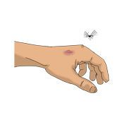 insect bite